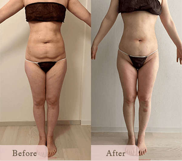 ba-2 - Titania|堺市ダイエットエステサロン 堺市ダイエットエステ|寝てるだけでLLサイズがMサイズに|人生最後のダイエット Titania-ティターニア-