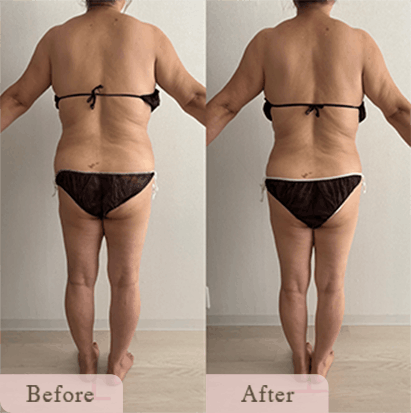 ba-img-16 - Titania|堺市ダイエットエステサロン 堺市ダイエットエステ|寝てるだけでLLサイズがMサイズに|人生最後のダイエット Titania-ティターニア-