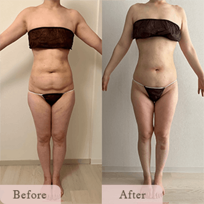 ba-img-3 - Titania|堺市ダイエットエステサロン 堺市ダイエットエステ|寝てるだけでLLサイズがMサイズに|人生最後のダイエット Titania-ティターニア-