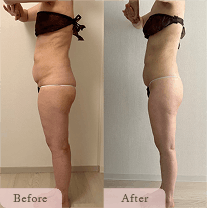 ba-img-4 - Titania|堺市ダイエットエステサロン 堺市ダイエットエステ|寝てるだけでLLサイズがMサイズに|人生最後のダイエット Titania-ティターニア-